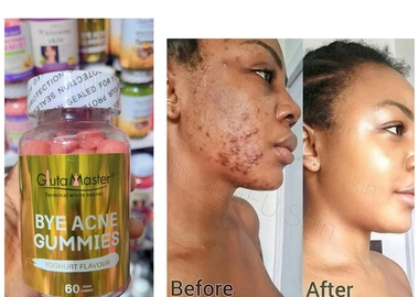Acne remover gummies