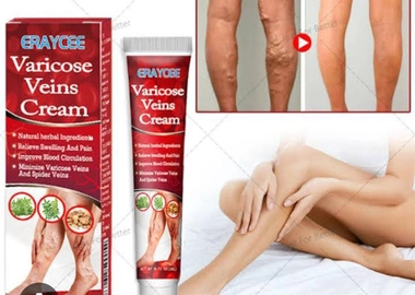 Varicose veins cream