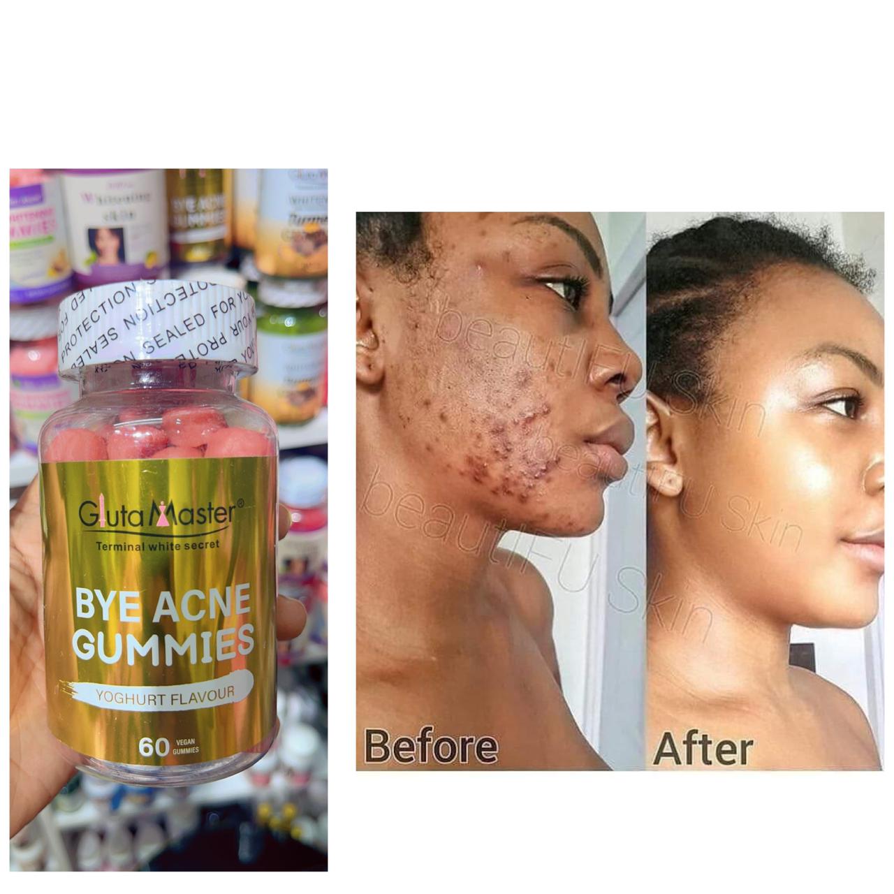 Acne remover gummies