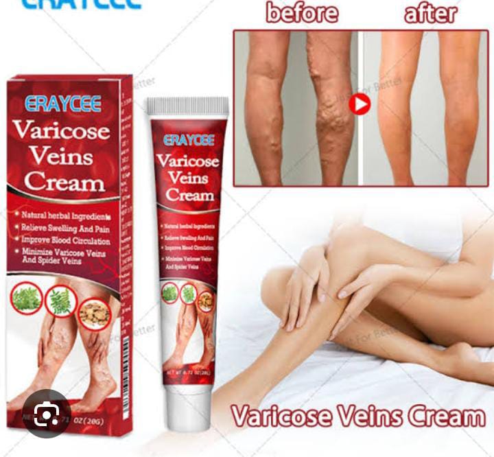 Varicose veins cream